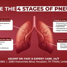 What Are The 4 Stages Of Pneumonia?